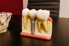 Iată ce trebuie să știi înainte de a îți pune implant dentar!